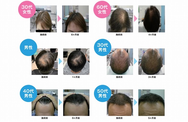 幹細胞で発毛促進(Grotty Pro)